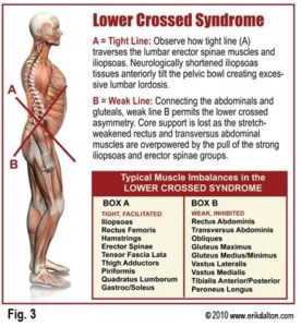 Diagram of Lower Crossed Syndrome