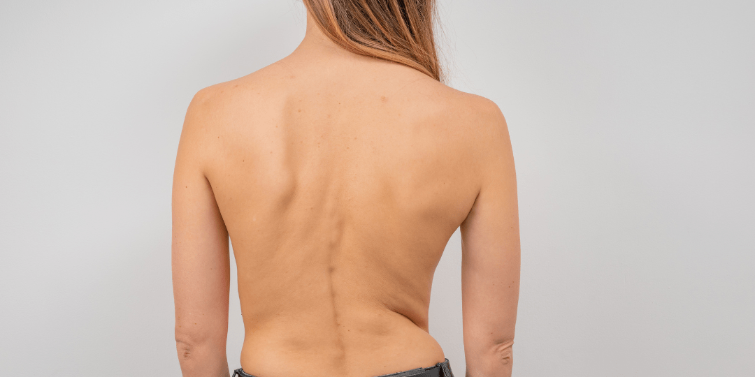 Woman with scoliosis