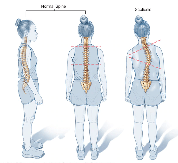 Normal spine compared to a spine with scoliosis