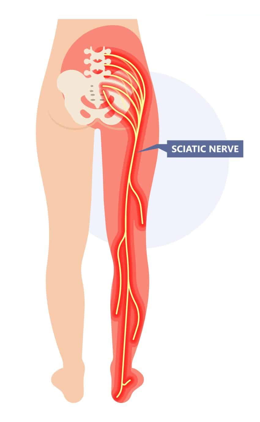 Diagram of the sciatic nerve