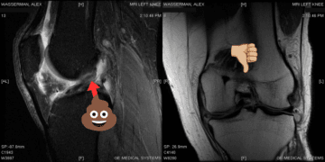 A Personal Health Update: My Upcoming ACL & Meniscus Surgery